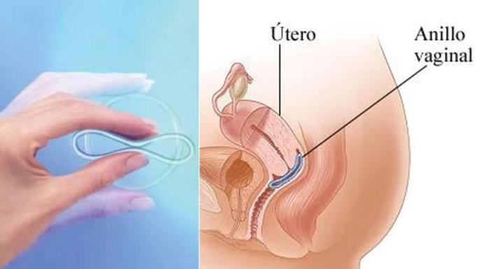Anillo vaginal, preguntas y respuestas