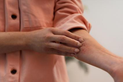 Dermatitis en los meses calurosos: así afectan el polen, el sudor y el calor a tu piel sensible