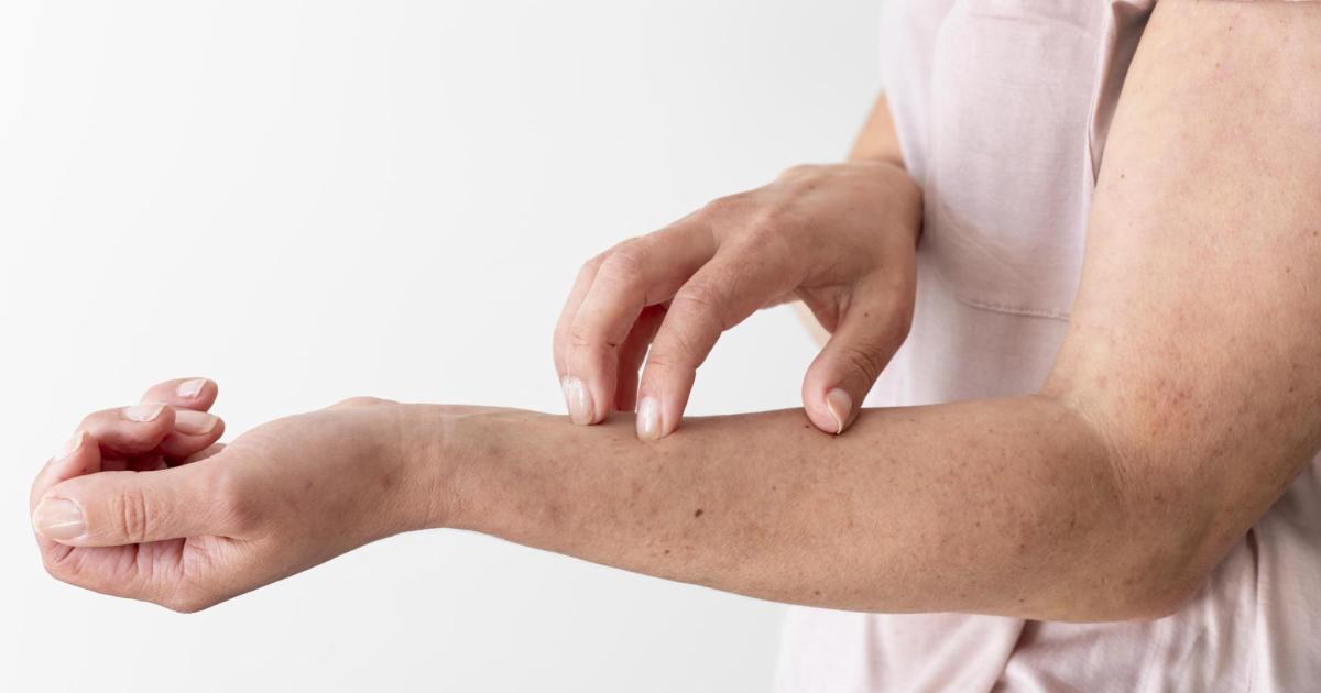 Dermatitis atópica: cómo el picor y las lesiones afectan la vida diaria y el bienestar emocional